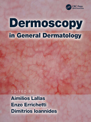 cover image of Dermoscopy in General Dermatology